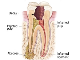 川勝歯科歯内療法patientendo.jpg